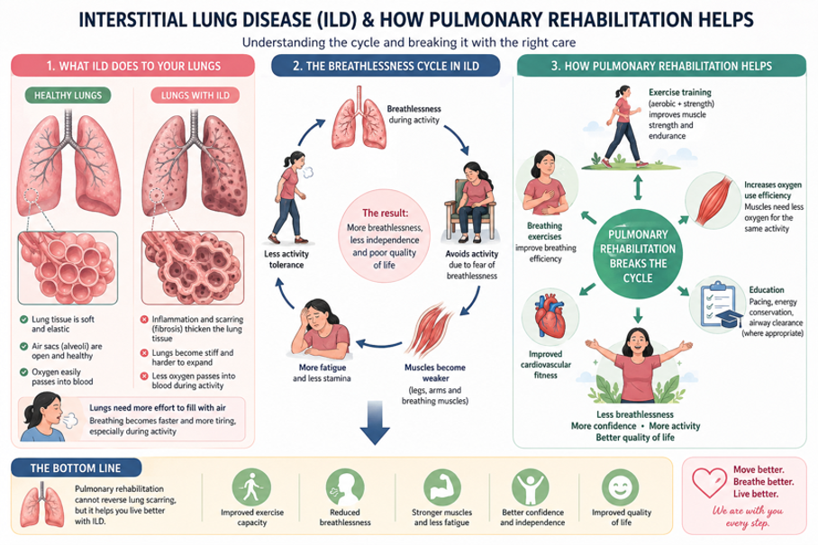 Infographic showing how interstitial lung disease scars the lungs, the breathlessness cycle of avoiding activity and weaker muscles, and how pulmonary rehabilitation breaks that cycle.
